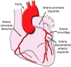 Infarto agudo de miocardio
